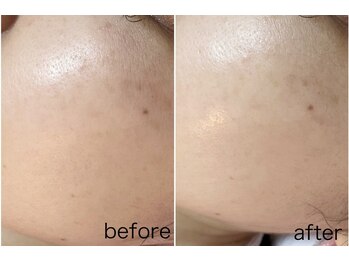 毛穴塾/【韓国最新美容】ララピール