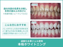 クレア(Crea)/【歯のホワイトニング症例写真】