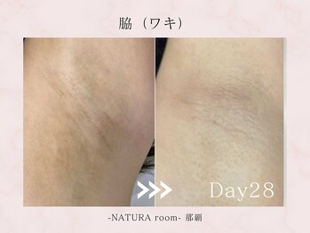 ナチュラルーム 那覇(NATURA room)/ローマピンク/わき施術
