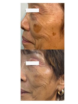 エラン(ELAN)/【Dr,sハーブピーリング】