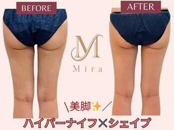 ミラ 札幌店(Mira)/美脚×ハイパーナイフ