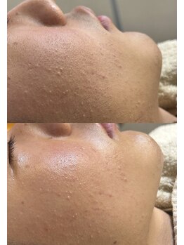 スイ 四条烏丸(SUI)/〇全顔シェービング