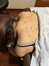 代々木美容鍼灸サロン さくら/首肩鍼灸