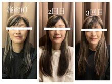 アイリー(Irie)/小顔矯正