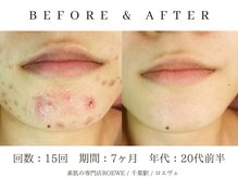 ロエヴェ(ROEWE)/ニキビ改善・毛穴ケア・肌質改善