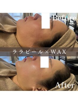 エピナ 千葉店(Epina)/全顔WAX＋ララピール☆