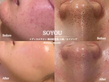 ソユ(SOYOU)の雰囲気（《ニキビ改善・黒ずみ・皮脂・開き毛穴》ハーブピーリング必須）