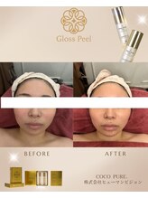 ココセンガビューティークリニック 恵比寿(COCO SENGA Beauty-Clinic)/『Gloss.Peel』Before/After