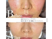 エム(M)/REVIハーブピーリング