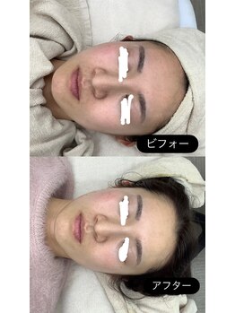 メリアミーゴ(Meli amigo)/30代 ハーブピーリング