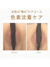 サロン ド ベル(Salon de Belle)/VIO黒ずみ変化