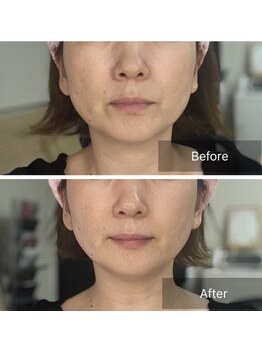 タカキ(TAKAKI)/超最新リフトアップの機械