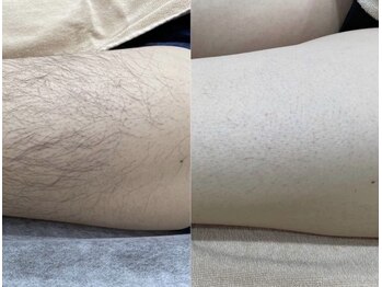 エピア 豊田店(Epia)/最短6ヵ月【シェービング付】