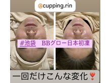 カッピングアンドカッサ専門店 凜(Rin)/BBグローフェイシャル【卵肌】★