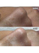 ライカブルー(RaicA BluE)/施術写真　before-after