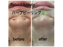 リラックスアンドビューティ(Relax&Beauty)の雰囲気（当店自慢の 新!!肌質改善ハイドラフェイシャル&ハーブピーリング）
