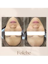 フォルチェ ゆめタウン広島店(Folche)/エステで美白を手に！！