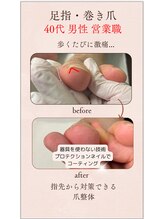 プルーヴ(PROVE)/爪整体:巻き爪