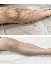 ビアンカ(BIANCA)/石岡市姉妹店HAIKARASAN脚脱毛