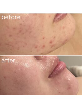 ジェノール 2nd beauty studio 姫路駅前店(JNOEL)/諦めないで！本気の肌質改善