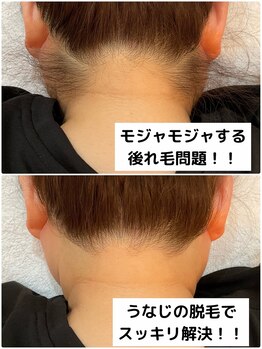 プレヴェール 神戸三宮/うなじ脱毛