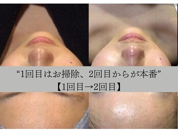 ラリマ グラマラス(Larima Glamorous)/毛穴を整えると、透明感は育つ