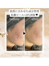 ビヌ(Binu)/乳酸ピール＋IPLフォトのWケア