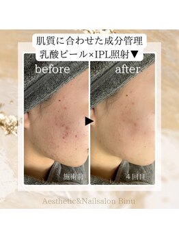ビヌ(Binu)/乳酸ピール+IPLフォトのWケア