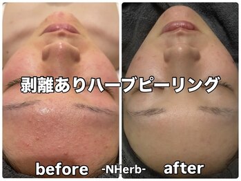 エヌハーブ(NHerb)の写真/多治見にハーブピーリング専門店がOPEN☆お悩みご相談ください◎毛穴ケア/ツヤ肌/美白/しみしわケア
