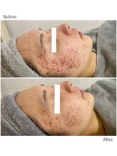 ダリア/ハーブピーリング