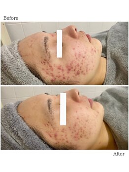 ダリア/ハーブピーリング