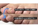 ヒールで激痛…原因は巻き爪