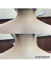 ベルビー エルエル岡崎店/襟足剃りビフォーアフター