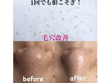 ビューティーネイル(Beauty Nail)/毛穴エクストラクション