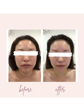 サロンドメネラ(salon de menera)/オプションで選べる小顔調整