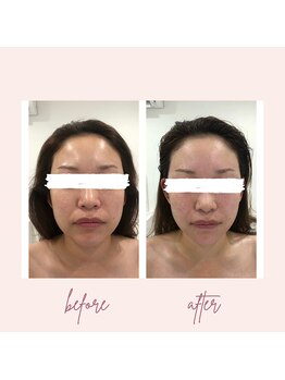 サロンドメネラ(salon de menera)/オプションで選べる小顔調整