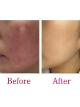 ベレミアム(Bellemium)/30代女性敏感肌