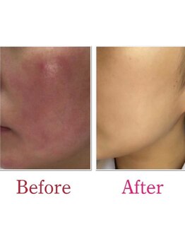 ベレミアム(Bellemium)/30代女性敏感肌