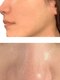 インディバ サロン フォーエバー(Forever)の写真/乖離なし!肌の汚れを除去し,7種類のコラーゲン導入で引き締まったお肌に☆ニキビ肌荒れを改善させ肌質改善!