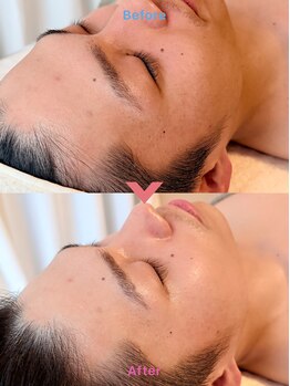 エテル(eter)/セラピール1回目