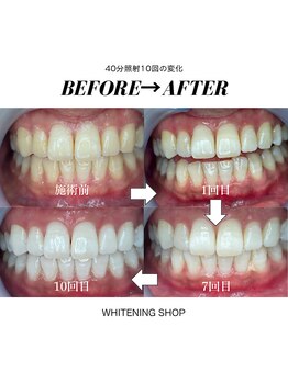 ホワイトニングショップ 茨木店/10回施術後の比較写真