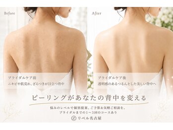 リベル 名古屋(Lebelle:)の写真/《矢場町駅1分》全国から来店実績のハーブピーリング専門店!二の腕/背中のニキビケア★詳細はブログをcheck