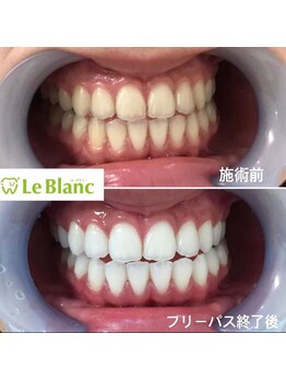 ルブラン 奈良店(Le Blanc)/満足いく白さに!!