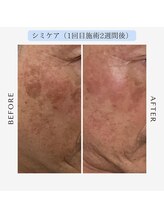 ジール(GIILL)/男性シミケアビフォーアフター