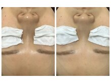 ルル(RuRu)/W水光ピール