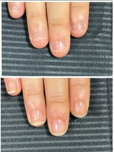 ルカロンネイル(Rukaron Nail)/伸びてこなくなってしまった爪