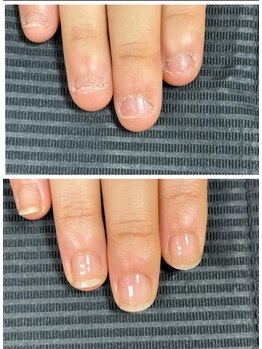 ルカロンネイル(Rukaron Nail)/伸びてこなくなってしまった爪