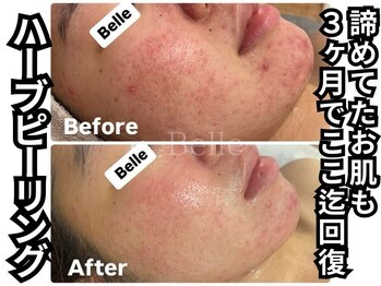 ベル 心斎橋店(Belle)/ハーブピーリング