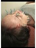 【話題の美容鍼★】美顔鍼+全身の鍼灸マッサージ90分16500円→15500円