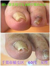 巻き爪じゅん 千葉駅前店/硬い巻き爪でも1回で変われた！